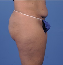 Tummy Tuck Before Photo by Katerina Gallus, MD, FACS; San Diego, CA - Case 45321