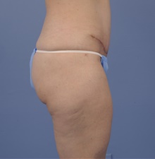 Tummy Tuck After Photo by Katerina Gallus, MD, FACS; San Diego, CA - Case 45322