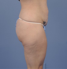 Tummy Tuck Before Photo by Katerina Gallus, MD, FACS; San Diego, CA - Case 45322