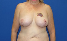 Breast Lift After Photo by Katerina Gallus, MD, FACS; San Diego, CA - Case 45324