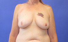 Breast Lift Before Photo by Katerina Gallus, MD, FACS; San Diego, CA - Case 45324