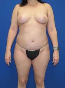 Liposuction Before Photo by Katerina Gallus, MD, FACS; San Diego, CA - Case 45339