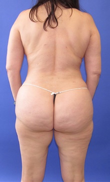 Liposuction After Photo by Katerina Gallus, MD, FACS; San Diego, CA - Case 45339