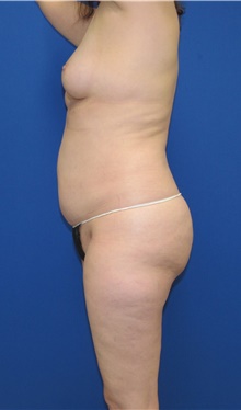 Liposuction Before Photo by Katerina Gallus, MD, FACS; San Diego, CA - Case 45339