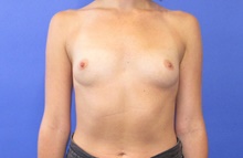 Breast Augmentation Before Photo by Katerina Gallus, MD, FACS; San Diego, CA - Case 45342