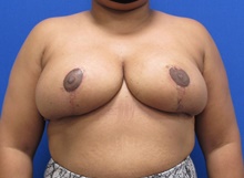 Breast Reduction After Photo by Katerina Gallus, MD, FACS; San Diego, CA - Case 45343