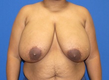Breast Reduction Before Photo by Katerina Gallus, MD, FACS; San Diego, CA - Case 45343