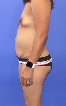 Tummy Tuck Before Photo by Katerina Gallus, MD, FACS; San Diego, CA - Case 45346