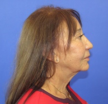 Neck Lift After Photo by Katerina Gallus, MD, FACS; San Diego, CA - Case 45359