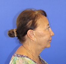 Neck Lift Before Photo by Katerina Gallus, MD, FACS; San Diego, CA - Case 45359