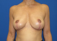 Breast Implant Removal After Photo by Katerina Gallus, MD, FACS; San Diego, CA - Case 45367