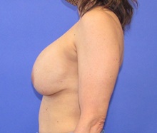 Breast Implant Removal Before Photo by Katerina Gallus, MD, FACS; San Diego, CA - Case 45367