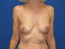 Breast Implant Removal After Photo by Katerina Gallus, MD, FACS; San Diego, CA - Case 45370
