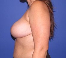 Breast Reduction After Photo by Katerina Gallus, MD, FACS; San Diego, CA - Case 45371