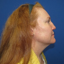 Neck Lift Before Photo by Katerina Gallus, MD, FACS; San Diego, CA - Case 45372