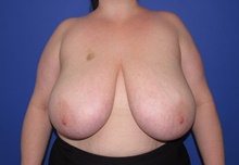 Breast Reduction Before Photo by Katerina Gallus, MD, FACS; San Diego, CA - Case 45373