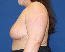 Breast Reduction After Photo by Katerina Gallus, MD, FACS; San Diego, CA - Case 45373