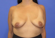 Breast Augmentation Before Photo by Katerina Gallus, MD, FACS; San Diego, CA - Case 45374