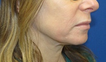 Laser Skin Resurfacing After Photo by Katerina Gallus, MD, FACS; San Diego, CA - Case 45377