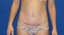 Tummy Tuck After Photo by Katerina Gallus, MD, FACS; San Diego, CA - Case 45409