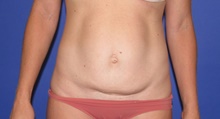 Tummy Tuck Before Photo by Katerina Gallus, MD, FACS; San Diego, CA - Case 45409