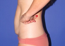 Tummy Tuck Before Photo by Katerina Gallus, MD, FACS; San Diego, CA - Case 45409