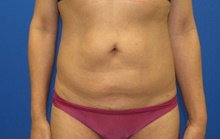 Liposuction Before Photo by Katerina Gallus, MD, FACS; San Diego, CA - Case 45432