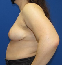Breast Reduction After Photo by Katerina Gallus, MD, FACS; San Diego, CA - Case 45455