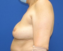 Breast Implant Revision Before Photo by Katerina Gallus, MD, FACS; San Diego, CA - Case 45456