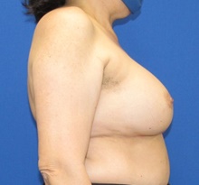Breast Implant Revision After Photo by Katerina Gallus, MD, FACS; San Diego, CA - Case 45456
