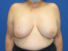 Breast Implant Removal Before Photo by Katerina Gallus, MD, FACS; San Diego, CA - Case 45464