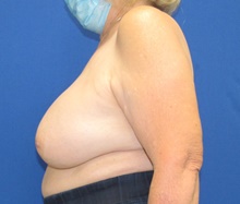 Breast Implant Removal Before Photo by Katerina Gallus, MD, FACS; San Diego, CA - Case 45464