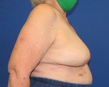 Breast Implant Removal After Photo by Katerina Gallus, MD, FACS; San Diego, CA - Case 45464