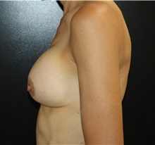 Breast Implant Removal Before Photo by Katerina Gallus, MD, FACS; San Diego, CA - Case 45491