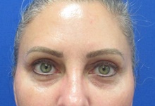 Eyelid Surgery After Photo by Katerina Gallus, MD, FACS; San Diego, CA - Case 45495