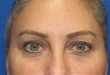 Eyelid Surgery Before Photo by Katerina Gallus, MD, FACS; San Diego, CA - Case 45495