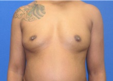 Breast Augmentation Before Photo by Katerina Gallus, MD, FACS; San Diego, CA - Case 45497