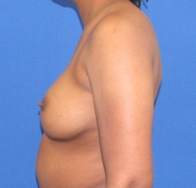 Breast Augmentation After Photo by Katerina Gallus, MD, FACS; San Diego, CA - Case 45497
