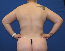 Liposuction Before Photo by Katerina Gallus, MD, FACS; San Diego, CA - Case 45499