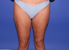 Liposuction Before Photo by Katerina Gallus, MD, FACS; San Diego, CA - Case 45505
