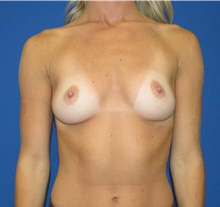 Breast Augmentation Before Photo by Katerina Gallus, MD, FACS; San Diego, CA - Case 45508