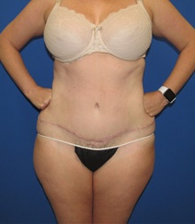 Tummy Tuck After Photo by Katerina Gallus, MD, FACS; San Diego, CA - Case 45604