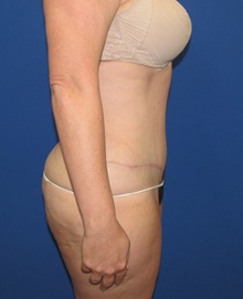 Tummy Tuck After Photo by Katerina Gallus, MD, FACS; San Diego, CA - Case 45604