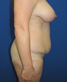 Tummy Tuck Before Photo by Katerina Gallus, MD, FACS; San Diego, CA - Case 45604