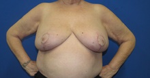 Breast Reduction After Photo by Katerina Gallus, MD, FACS; San Diego, CA - Case 45605