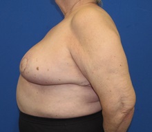 Breast Reduction After Photo by Katerina Gallus, MD, FACS; San Diego, CA - Case 45605