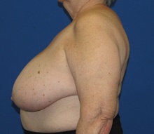 Breast Reduction Before Photo by Katerina Gallus, MD, FACS; San Diego, CA - Case 45605