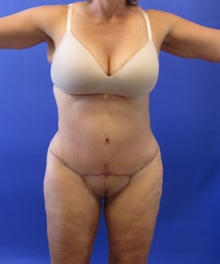 Tummy Tuck After Photo by Katerina Gallus, MD, FACS; San Diego, CA - Case 45853
