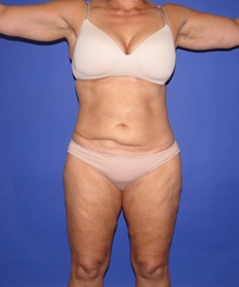 Tummy Tuck Before Photo by Katerina Gallus, MD, FACS; San Diego, CA - Case 45853