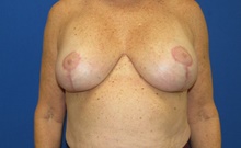 Breast Implant Revision After Photo by Katerina Gallus, MD, FACS; San Diego, CA - Case 45854